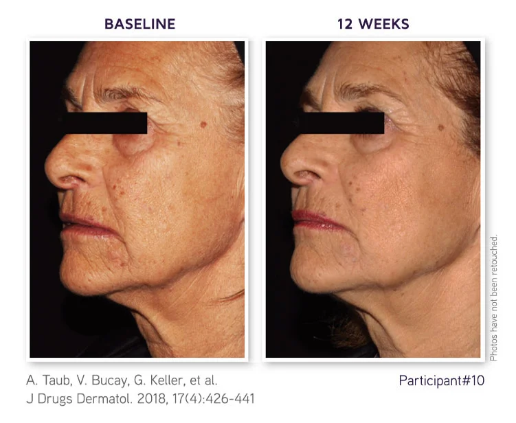 A study participant in profile at baseline and after 12 weeks: finer lines and more even tone around the eye, cheek and jaw