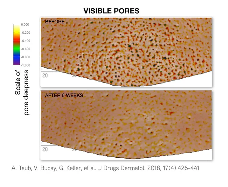3D skin scans of visible pores before and after 6 weeks, with fewer and shallower pores after